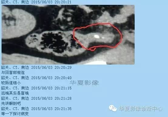 教你如何快捷、准确的找到阑尾并分析病变