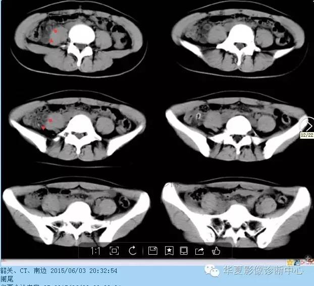 教你如何快捷、准确的找到阑尾并分析病变