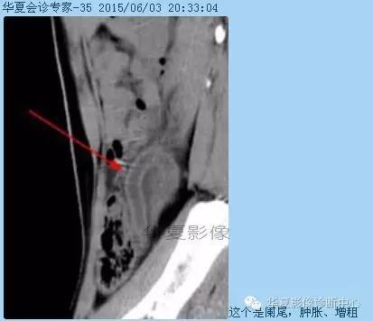 教你如何快捷、准确的找到阑尾并分析病变