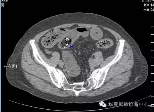 教你如何快捷、准确的找到阑尾并分析病变