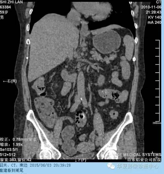 教你如何快捷、准确的找到阑尾并分析病变