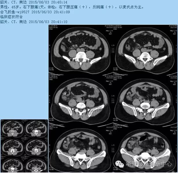 教你如何快捷、准确的找到阑尾并分析病变