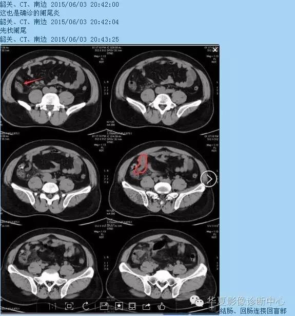 教你如何快捷、准确的找到阑尾并分析病变