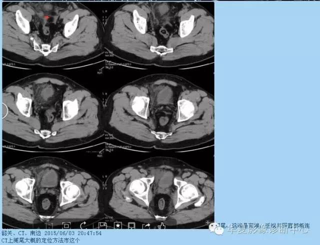 教你如何快捷、准确的找到阑尾并分析病变