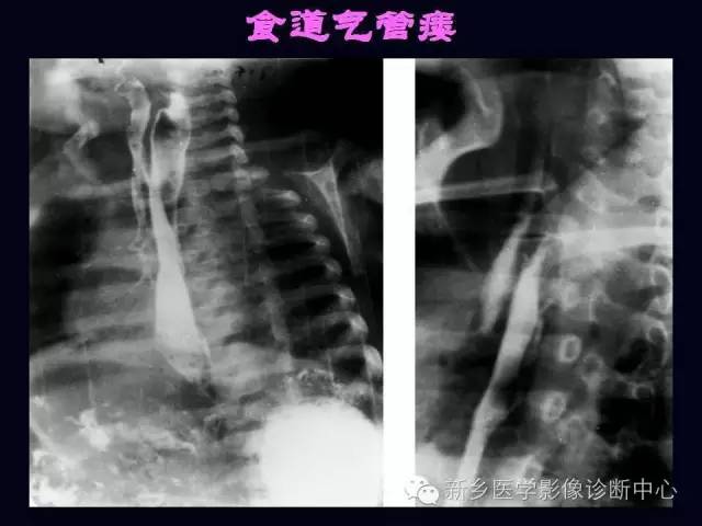 【PPT】小儿腹部急症的X线诊断