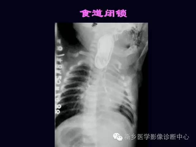 【PPT】小儿腹部急症的X线诊断