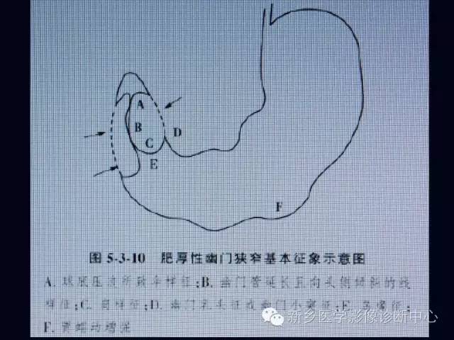 【PPT】小儿腹部急症的X线诊断