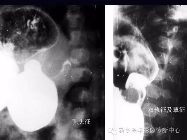 【PPT】小儿腹部急症的X线诊断