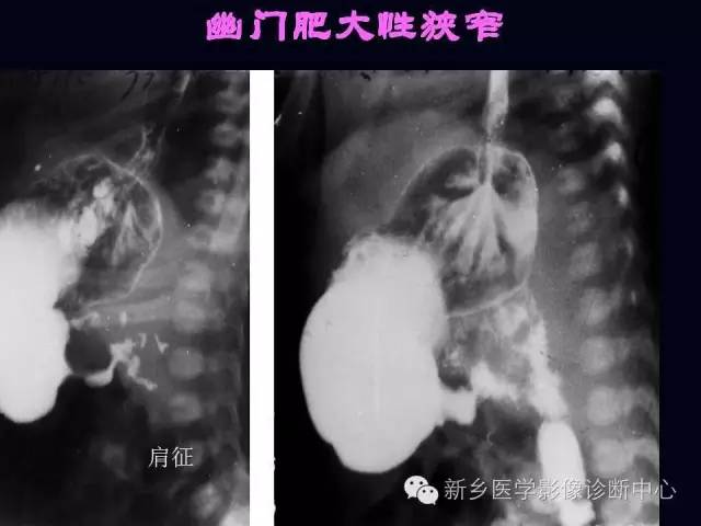 【PPT】小儿腹部急症的X线诊断