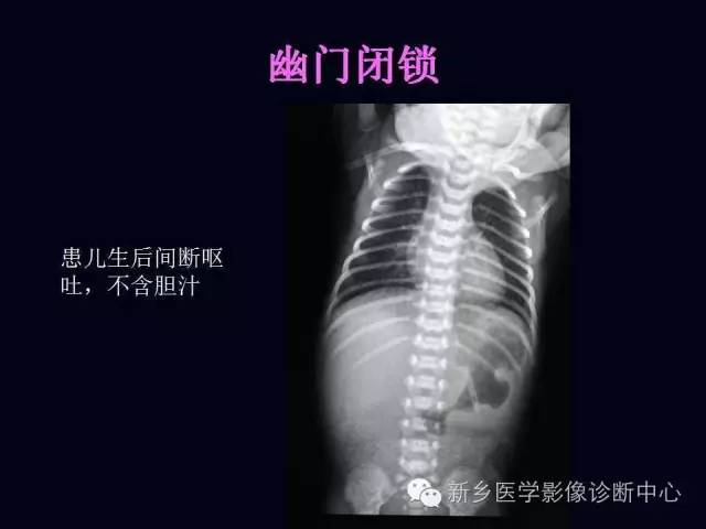 【PPT】小儿腹部急症的X线诊断