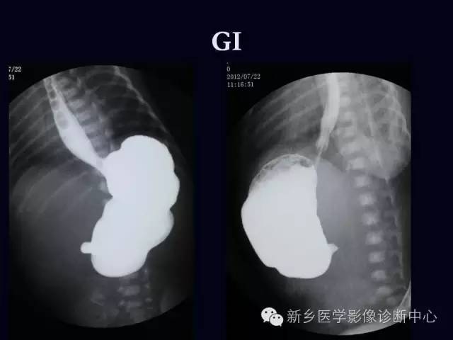 【PPT】小儿腹部急症的X线诊断