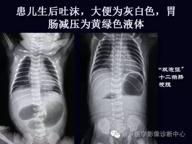 【PPT】小儿腹部急症的X线诊断