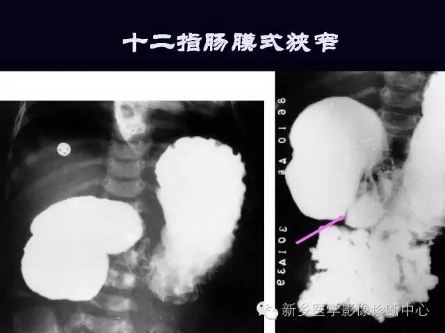 【PPT】小儿腹部急症的X线诊断