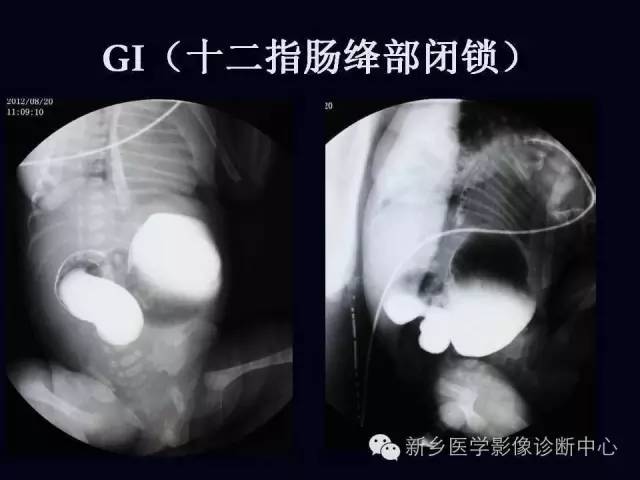 【PPT】小儿腹部急症的X线诊断