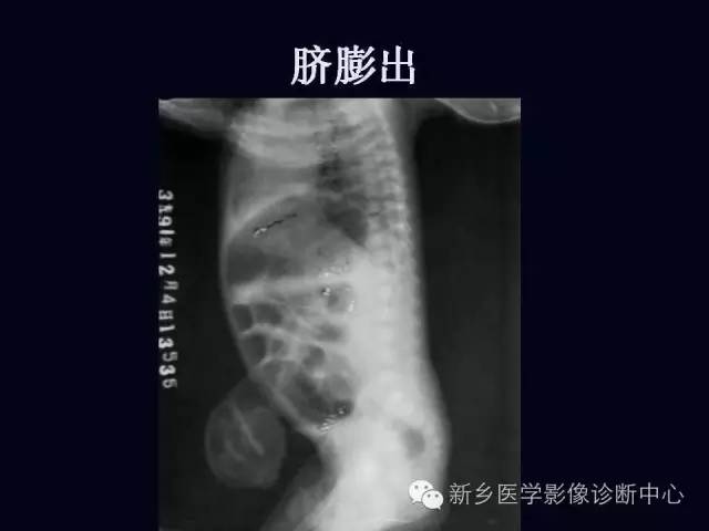 【PPT】小儿腹部急症的X线诊断