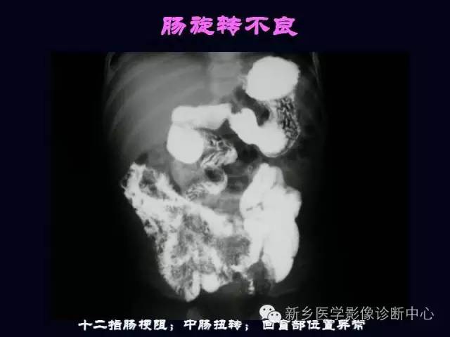 【PPT】小儿腹部急症的X线诊断