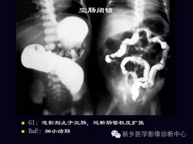 【PPT】小儿腹部急症的X线诊断
