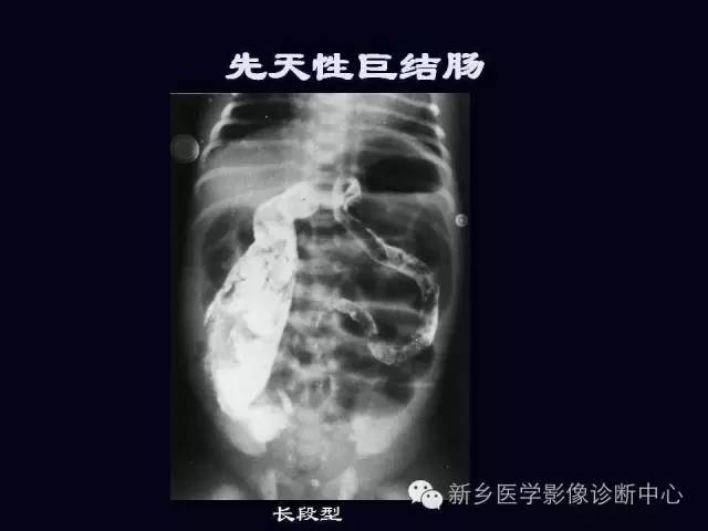 【PPT】小儿腹部急症的X线诊断