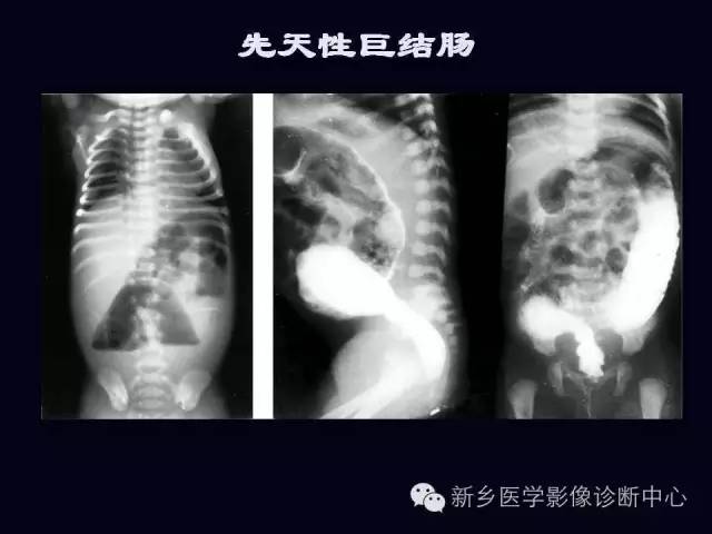 【PPT】小儿腹部急症的X线诊断