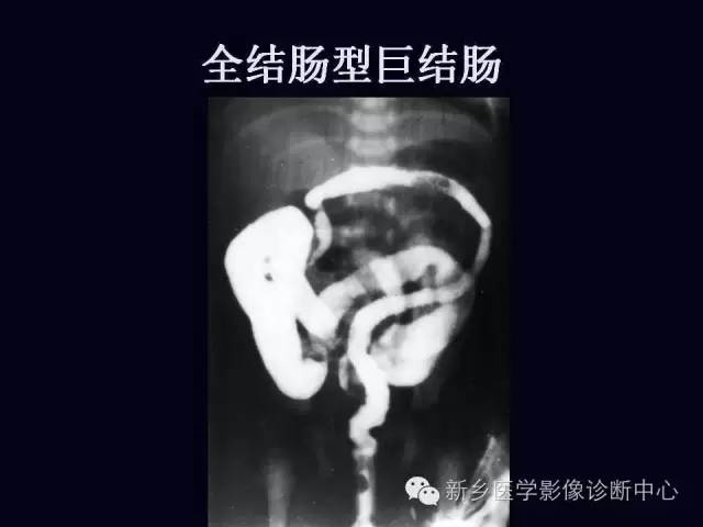 【PPT】小儿腹部急症的X线诊断