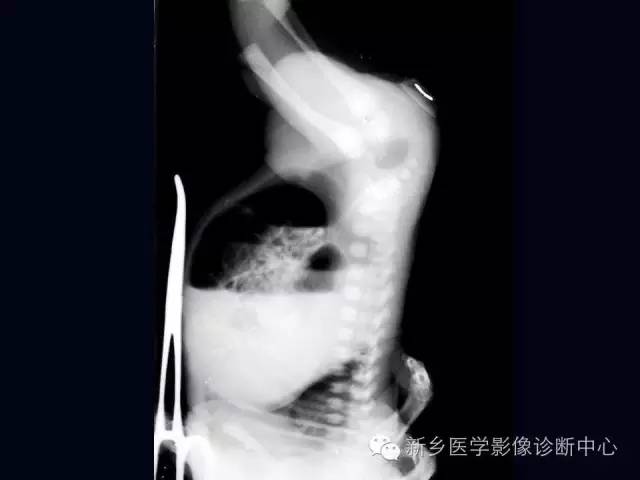 【PPT】小儿腹部急症的X线诊断