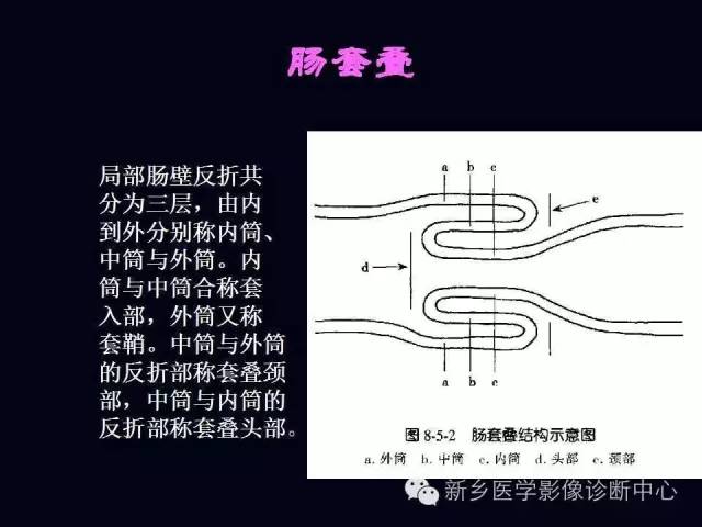 【PPT】小儿腹部急症的X线诊断