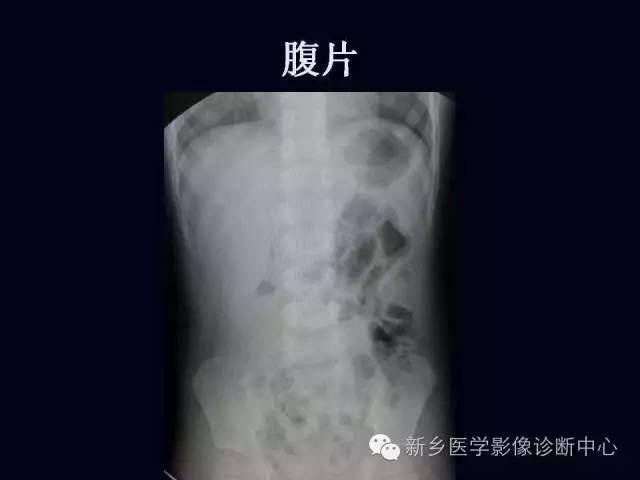 【PPT】小儿腹部急症的X线诊断