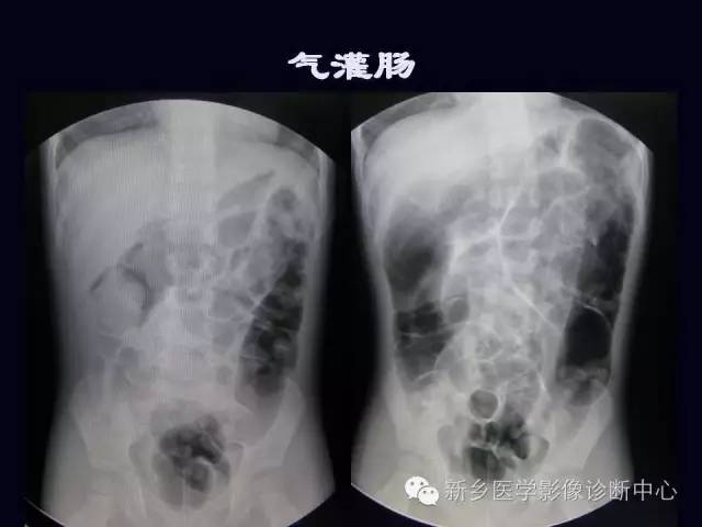 【PPT】小儿腹部急症的X线诊断