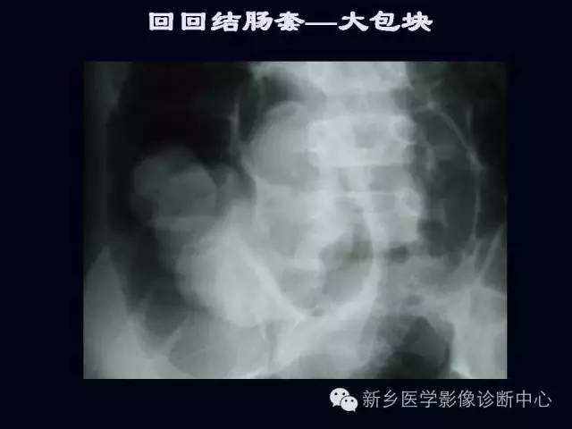 【PPT】小儿腹部急症的X线诊断