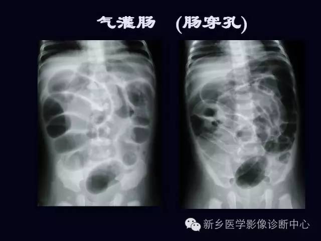 【PPT】小儿腹部急症的X线诊断