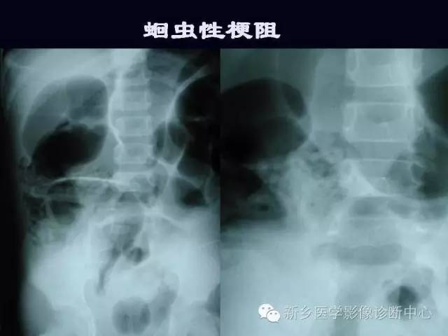 【PPT】小儿腹部急症的X线诊断