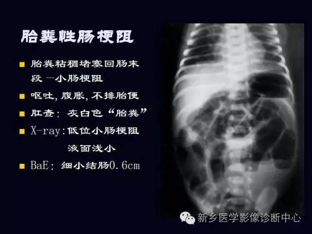 【PPT】小儿腹部急症的X线诊断