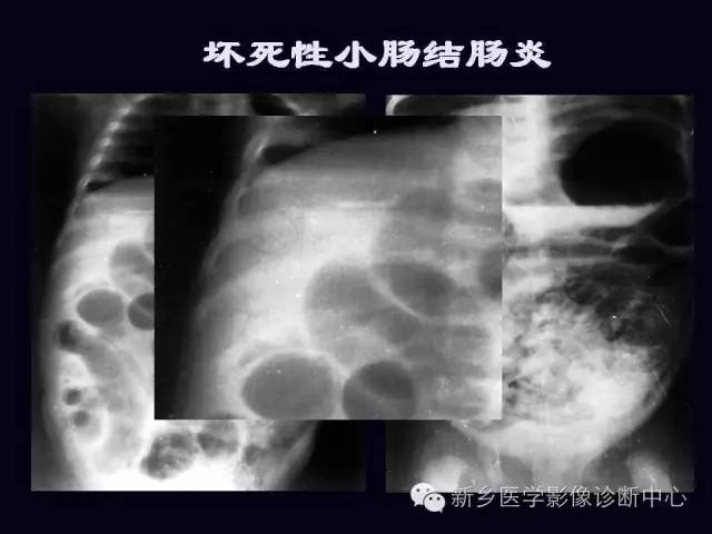 【PPT】小儿腹部急症的X线诊断