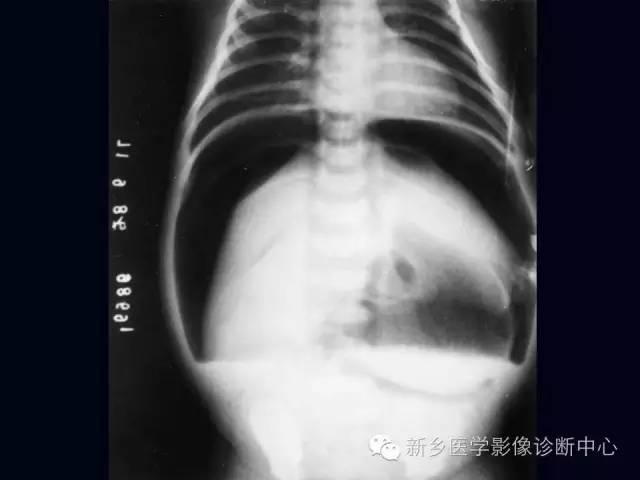 【PPT】小儿腹部急症的X线诊断