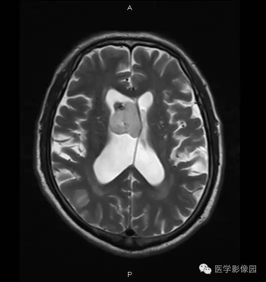 【病例】右侧侧脑室室管膜下瘤1例MR影像表现
