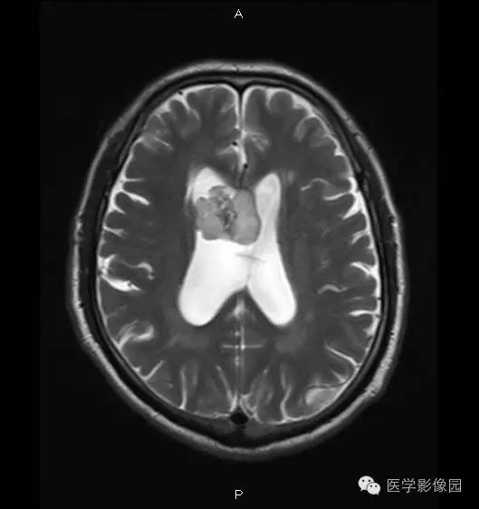 【病例】右侧侧脑室室管膜下瘤1例MR影像表现