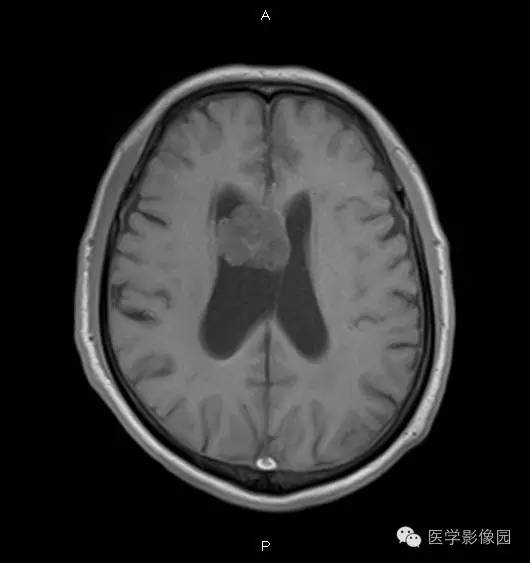 【病例】右侧侧脑室室管膜下瘤1例MR影像表现