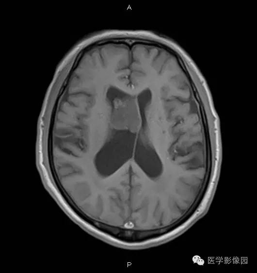 【病例】右侧侧脑室室管膜下瘤1例MR影像表现
