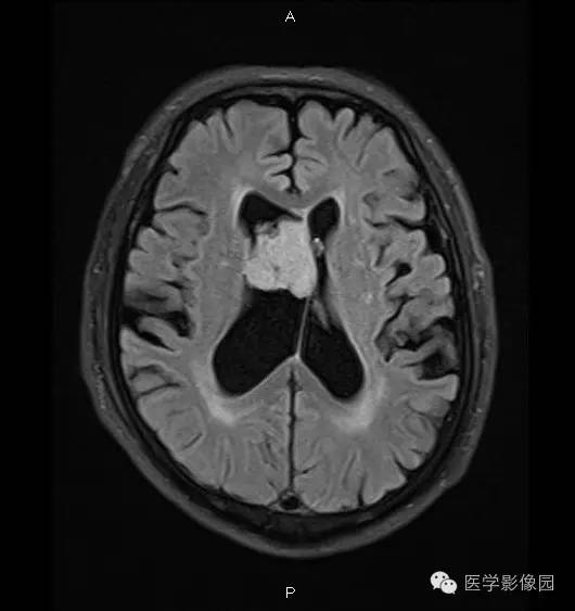 【病例】右侧侧脑室室管膜下瘤1例MR影像表现