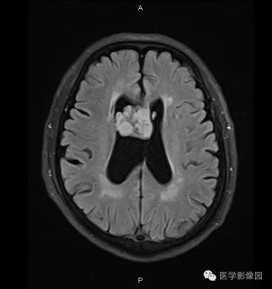 【病例】右侧侧脑室室管膜下瘤1例MR影像表现