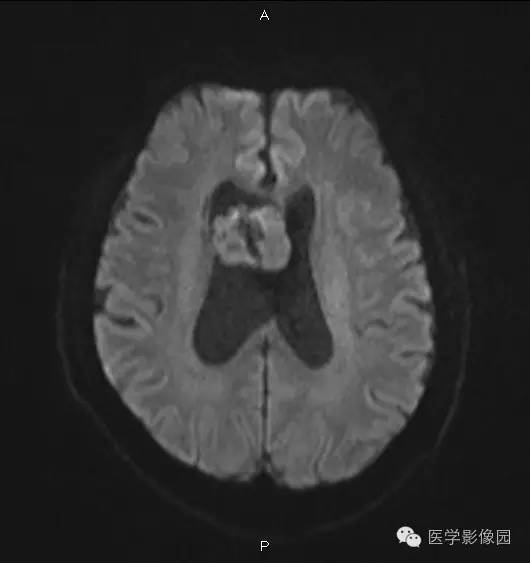 【病例】右侧侧脑室室管膜下瘤1例MR影像表现