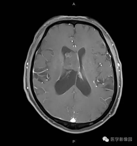 【病例】右侧侧脑室室管膜下瘤1例MR影像表现
