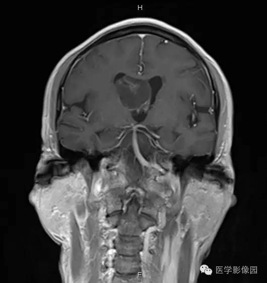【病例】右侧侧脑室室管膜下瘤1例MR影像表现