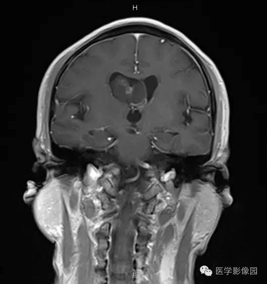 【病例】右侧侧脑室室管膜下瘤1例MR影像表现