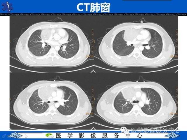 【病例】纵隔混合性生殖细胞瘤1例CT影像表现