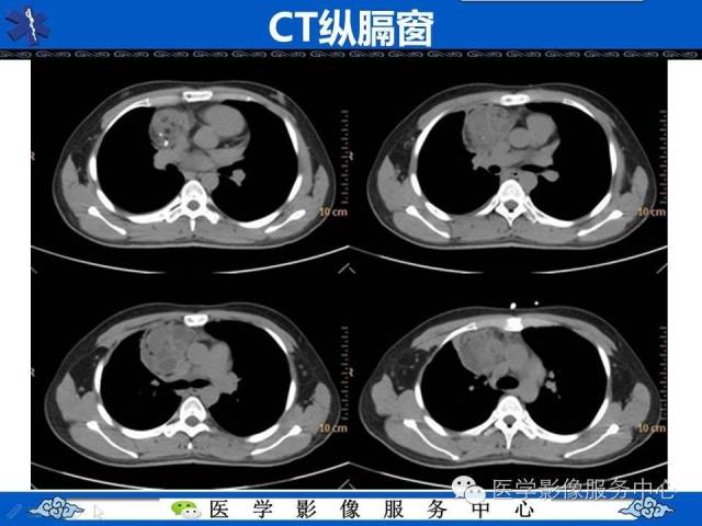 【病例】纵隔混合性生殖细胞瘤1例CT影像表现