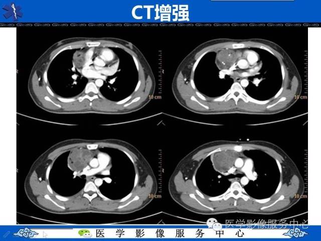 【病例】纵隔混合性生殖细胞瘤1例CT影像表现