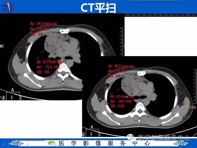 【病例】纵隔混合性生殖细胞瘤1例CT影像表现