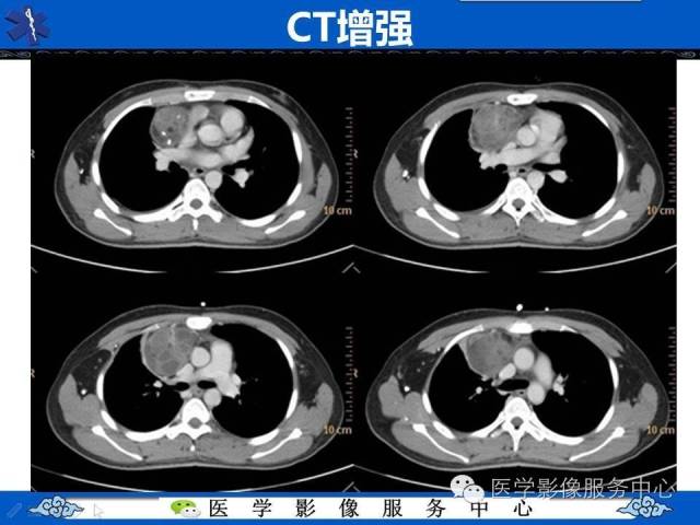 【病例】纵隔混合性生殖细胞瘤1例CT影像表现