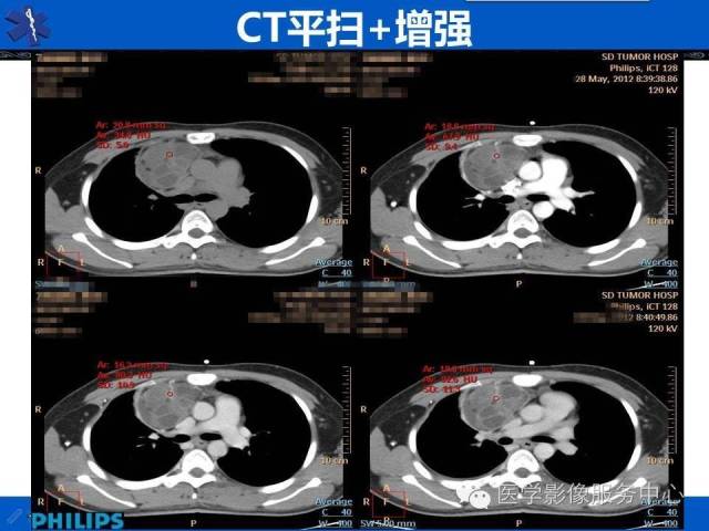 【病例】纵隔混合性生殖细胞瘤1例CT影像表现